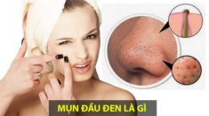 10 Cách trị mụn đầu đen ở mũi má trán an toàn hiệu quả nhanh nhất