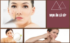 10 cách trị mụn ẩn dưới da tại nhà an toàn hiệu quả nhanh nhất