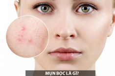 Cách trị mụn bọc sưng đỏ mủ ở mũi, cằm tại nhà an toàn hiệu quả