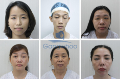 Thẩm mỹ viện Gangwhoo bật mí kỹ thuật sửa mắt sụp mí