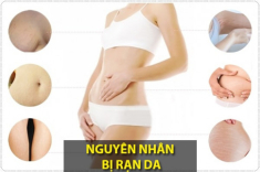 Trị rạn da sau sinh lâu năm hiệu quả nhanh nhất hiện nay