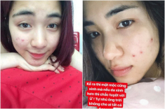Tưởng làn da hoàn hảo, dàn mỹ nhân cũng từng khóc ròng vì mụn chi chít kéo đầy lên mặt