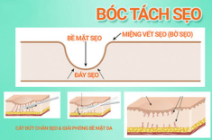 Xóa sẹo rỗ hiệu quả với phương pháp bóc tách sẹo