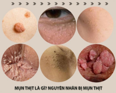 10 Cách trị mụn thịt tận gốc tại nhà hiệu quả nhất hiện nay