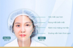 Căng da mặt bằng chỉ và những điều cần biết trước khi chị em quyết định chi tiền