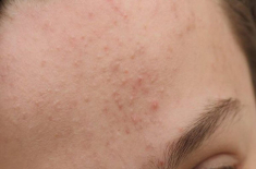 5 cách trị mụn ẩn trên trán tại nhà giúp nhân tự khắc trồi lên mà không cần nặn