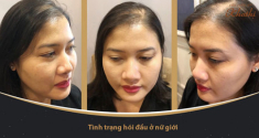 Giải pháp “cấp cứu” hiệu quả cho mái tóc thưa, mỏng của chị em