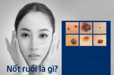 Tẩy nốt ruồi tại nhà và những lưu ý cần biết để tránh hậu quả khôn lường