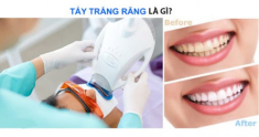 Tẩy trắng răng và những lưu ý cần biết về làm trắng răng tại nhà