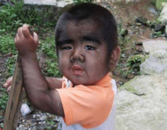 Cuộc sống sang chảnh hiện tại của cậu bé lông lá như người vượn từng gây sốc