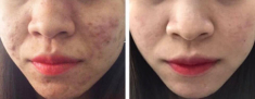 Hành trình “xoá” mụn, phục hồi của những làn da tưởng chừng không thể cứu vãn