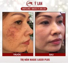 Hy vọng mới cho người bị nám da, tàn nhang