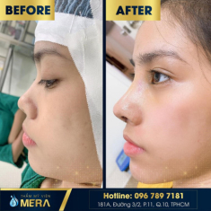Nâng mũi an toàn với phương pháp cấu trúc tại TMV Mera