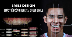 Thiết kế nụ cười – bước tiến công nghệ tại Queen Smile