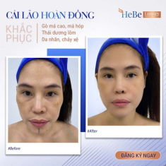 Bật mí về công nghệ “Cải lão hoàn đồng” khắc phục má hóp, gò má cao