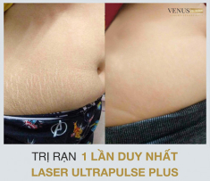U30, 40 tự tin chia sẻ bí quyết trị rạn da sau sinh