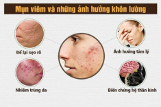 10 Cách trị mụn viêm sưng đỏ tại nhà an toàn hiệu quả