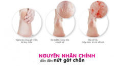 10 Cách trị nứt gót chân tại nhà tự nhiên an toàn hiệu quả nhanh nhất
