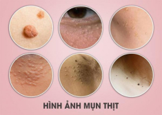 11 Cách trị mụn thịt tận gốc tại nhà an toàn hiệu quả nhanh nhất