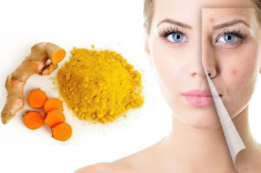 12 cách trị mụn thâm đơn giản an toàn hiệu quả nhanh nhất tại nhà