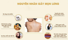 13 Cách trị mụn lưng từ nguyên liệu tự nhiên an toàn và hiệu quả nhất