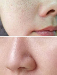 5 bí kíp thu nhỏ lỗ chân lông to và hạn chế luôn tình trạng dầu thừa không ai biết