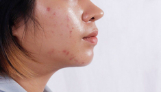 Cách chọn kem chống nắng cho da dầu mụn để cuối ngày da vẫn khô ráo
