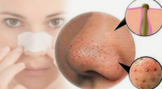 Cách trị mụn đầu đen tại nhà an toàn và hiệu quả