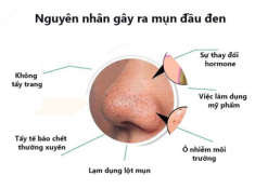 Cách trị mụn đầu đen tại nhà hiệu quả để có làn da trắng sáng mịn màng