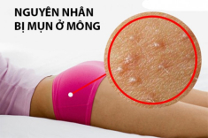 Cách trị mụn mông và thâm mông hiệu quả, an toàn tại nhà