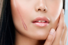 Cách trị sẹo lồi bằng các phương pháp tự nhiên an toàn hiệu quả nhanh nhất
