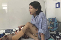 Cô gái bị chồng sắp cưới tạt axit nửa khuôn mặt giờ lột xác với diện mạo không nhận ra