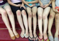 Có những vùng da không làm gì vẫn thâm đen, kể ra loạt nguyên nhân ai cũng mắc phải