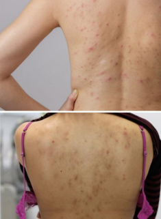 Dáng đẹp nhưng lưng mụn thâm chi chít, chị em chữa liền bây giờ vẫn kịp diện bikini