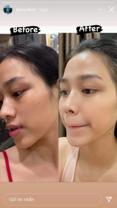 Đỗ Thị Hà “đu trend” dùng Acid lên mặt, da bong tróc nhưng kết quả sau 1 tháng mới phục