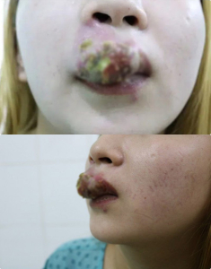 Đua nhau làm đẹp đón Tết, người suýt mù mắt vì tiêm filler, người môi mưng mủ vì xăm