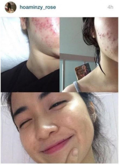 Hòa Minzy khóc ròng khi mặt bong tróc từng mảng nhăn nheo như bà già