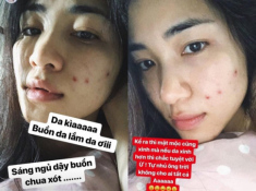 Hòa Minzy mỗi lần skincare hơn 1 tiếng, thanh lý cả rổ mụn nhờ chú trọng bước làm sạch