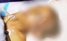 Mẹ làm theo mẹo dân gian đổ thuốc trừ sâu lên đầu diệt chấy, bé 11 tuổi nguy kịch