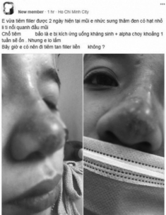 Mê tiêm filler giá rẻ, nhiều chị em đối mặt hậu quả rùng mình: mặt sưng, mũi mưng mủ