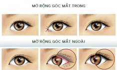 Mở góc mắt là gì mà được nhiều chị em quan tâm?