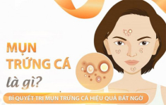 Mụn trứng cá xuất hiện do đâu và cách điều trị hiệu quả