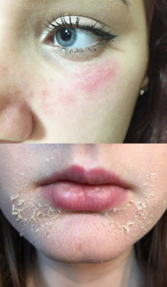 Nghe beauty blogger kể chuyện dùng Retinol/Tretinoin, chị em vơi bớt nỗi sợ “nát mặt”