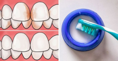 Răng bị ố vàng cứ áp dụng những cách này sẽ trắng sáng nhanh chóng