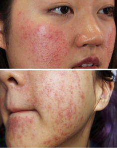 Rẻ-đẹp-dễ: Thực hư loại nước xông thải độc da bị nhiễm corticoid, sao Việt nhiều người áp dụng
