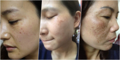 Rẻ-Đẹp-Dễ: Việt Nam may mắn có 1 loại lá chuyên trị nám, tìm đâu cũng có