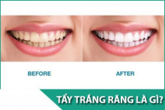 Tẩy trắng răng có hại gì với sức khỏe và những đối tượng không nên tẩy