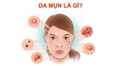 Cách chăm sóc da mụn và thâm đúng cách tại nhà hiệu quả nhanh nhất
