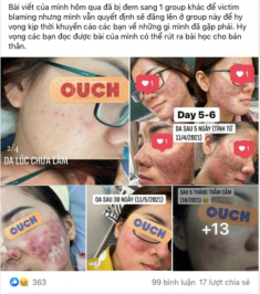 Đi peel da ở spa “rởm”, cô nàng kể chuyện bị cháy đỏ da, trầm cảm suốt 6 tháng trời