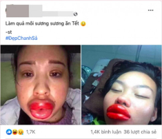Đi phun môi ăn Tết, gái xinh “số nhọ” nhận về cái kết môi sưng như quả chuối mắn